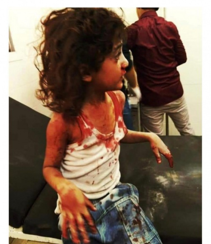 اصابة ثلاث صغيرات وأمهن بقذيفة حوثية بتعز