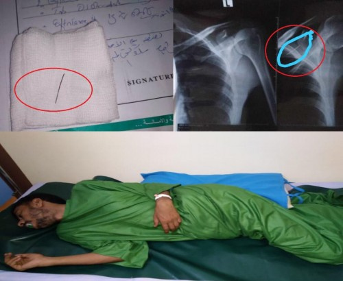 غرزت مسمار في ظهره... معتقل هرب من سجن ب#شبوة يكشف عن تعذيب وحشي تنفذه مليشيا الاصلاح (اخوان #اليمن) بحق المعتقلين ( وثائق)