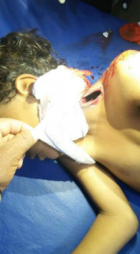 استشهاد طفل بقذيفة دبابة أطلقتها المليشيات الحوثية باتجاه قرية المشاريح بحجر شمال #الضالع (صور)