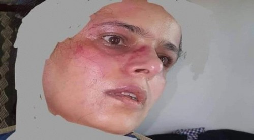 لانتقادها سياساتهم.. مليشيات الحوثي تُعذب ناشطة في منزلها بحجة (صورة)