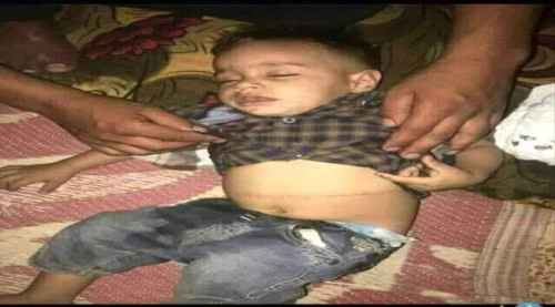 الحوثي يحول المستشفيات إلى مراكز الاتجار بالبشر