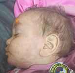 انتشار لمرض الحصبة بقرى المسيمير بلحج  والأهالي يناشدون السلطات الصحية